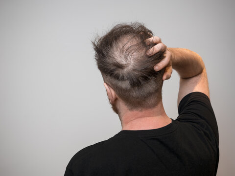 A single young caucasian male checking his bald patch on the back of his head, which shows clear signs of balding and hair loss. Shot against a white background with isolated man and room for text. 