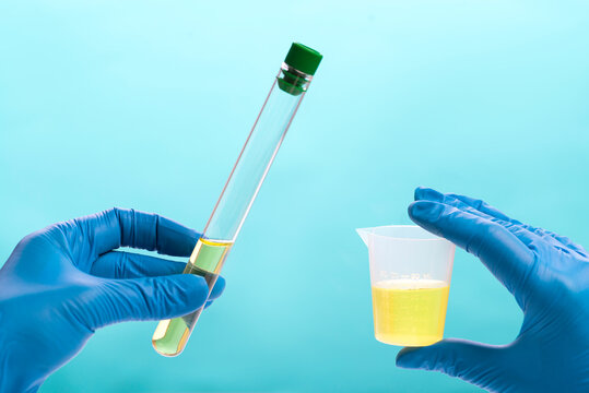 Urine analysis in the laboratory. Medical urine test. Urine sample for laboratory analysis