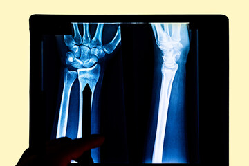 Person pointing at a X-ray of arm and hand