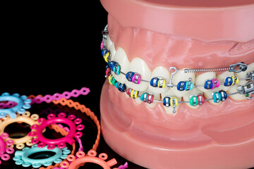 Close up  orthodontic model  - demonstration teeth model of varities of orthodontic bracket or brace