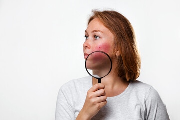 The concept of rosacea. Portrait of a caucasian woman showing redness on her cheeks, with a magnifying glass. Copy space. White background