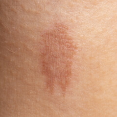 Fototapeta premium round skin burns from hot oil