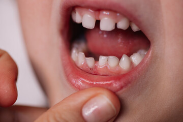 close-up the open mouth of a Caucasian child with the first baby tooth falling out and visible roots sticking out of the gum.