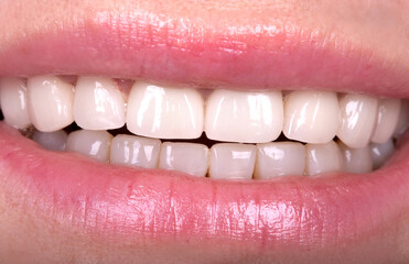 Perfect Close Up White beautiful Veneers Teeth bleaching crowns whitening young lady smiling,...