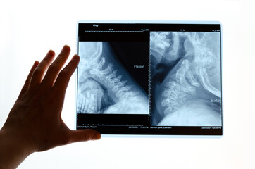 Fluorography. a snapshot of the x-ray of the cervical spine in four flexion-extension. The neck of a six-year-old.