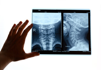 Fluorography. a snapshot of the x-ray of the cervical spine in four flexion-extension. The neck of a six-year-old.