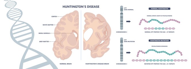 Obraz premium Huntington parkinson Motor alzheimer neuron brain DNA gene nerve cell juvenile problem defect genetic basal ganglia neuro repeat mutant damage testing defective mood inherits system family memory loss