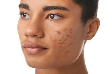 African-American teenage boy with acne problem on white background