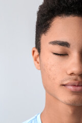 Fototapeta premium African-American teenage boy with acne problem on light background