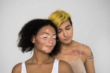 Vitiligo skin girl and woman with color skin and tattoos posing together