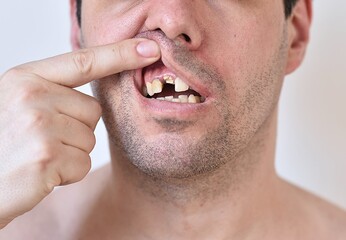 portrait of a man with broken teeth