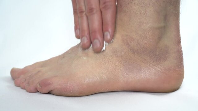 A man smears ointment on a leg on which a hygroma. Articular hernia on the leg. Closeup.