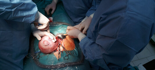 Abdominal hysterectomy. Womb is removed through a cut in the lower tummy.