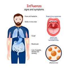 Influenza. the flu. Signs and symptoms of infectious disease