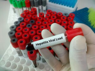 Blood sample for Hepatitis viral load test