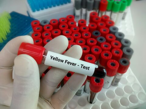 Scientist hold test tube with blood sample for yellow fever test