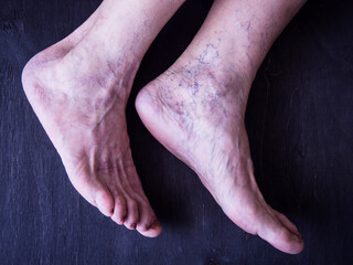 Varicose veins on the legs of an elderly woman on a black background.