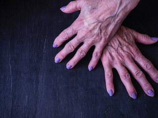 Varicose veins on the hands of an elderly woman on a black background.