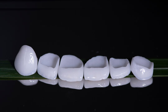 Aesthetic dentistry porcelain veneers cementation.