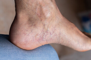 Adult man's foot with varicose veins