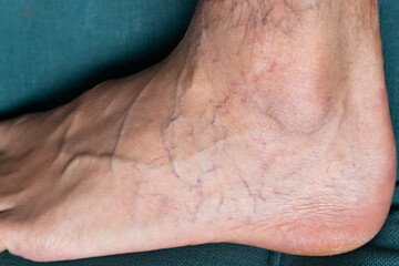 Fototapeta premium Adult man's foot with varicose veins