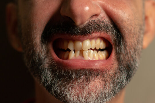 Mouth of bearded man showing crooked teeth