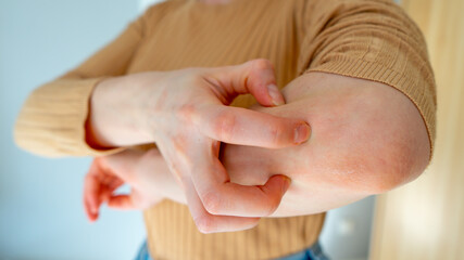 Young woman scratches the itching on her hands with a reddening rash. Itching is caused by dermatitis (eczema), dry skin, burns, food, drug allergies, insect bites. Health care concept.