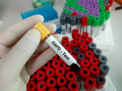 Blood sample for G6PD (glucose-6-phosphate dehydrogenase) test, genetic disorder