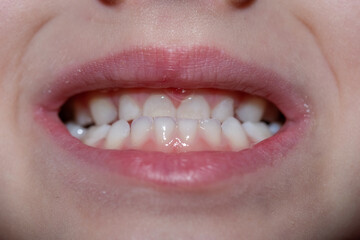Malocclusion of a child, close-up on the front teeth of a child