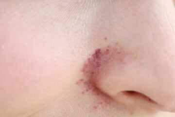 Obraz premium Rash on skin near woman nose closeup