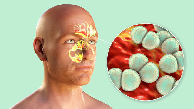 Purulent inflammation of frontal, maxillary, and ethmoid sinuses and close-up view of pneumococci bacteria