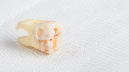 Pulled out wisdom tooth with filling and caries on white cheesecloth background. Close up of bad wisdom tooth