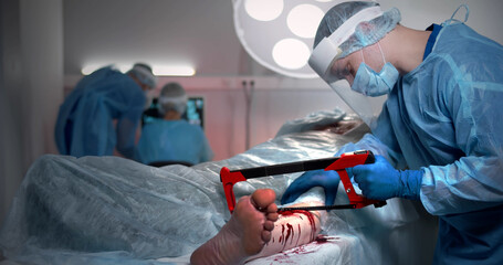 Surgeon using amputating saw amputating patient leg in operating room