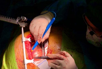 Surgeon was harvesting left internal mammary artery (LIMA) for use in coronary artery bypass graft...
