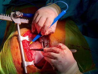 Surgeon was harvesting left internal mammary artery (LIMA) for use in coronary artery bypass graft...