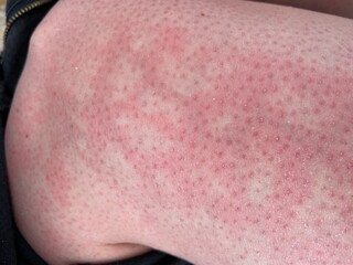 hives heat rash EAI Erythema ab igne allergy reaction on knee close-up reference picture of blotchy...