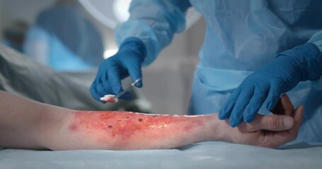 Surgeons team working with burn wound on arm of patient in operating room. - Powered by Adobe