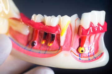 Tooth decay dental model