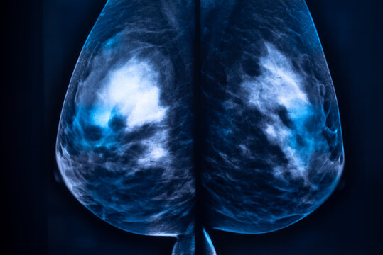Breast mamogram xray test