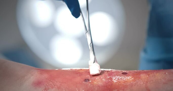Close up of surgeon hand in gloves holding tampon and cleaning patient wound