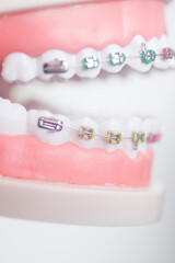 Dental teeth aligners brackets