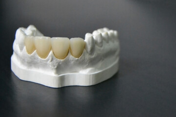 Fototapeta na wymiar White front teeth veneers on diagnostic model on dark background