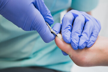 
Professional pedicure using a corrective brace. A podiatrist doctor treats a patient's ingrown toenail. - obrazy, fototapety, plakaty
