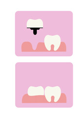 Vector illustration of teeth on a pink background. Dental implants. Dental implantation surgery. White, even teeth. Dentistry.
