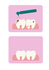 Vector illustration of teeth on a pink background. Caries from sweets. Consequences of eating sweets. Bad teeth.
Sugar harm. Poor care and its consequences. Dentistry. Teeth drilling machine. Teeth st