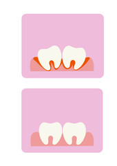 Vector illustration of teeth on a pink background. Bleeding. Periodontal disease. Bad teeth.
Poor care and its consequences. Before and after the treatment of periodontal disease. Dentistry.