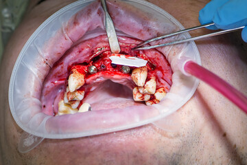 Surgery operation to install four dental implants on the upper jaw. Dental care and treatment. Teeth problems. © gorynvd