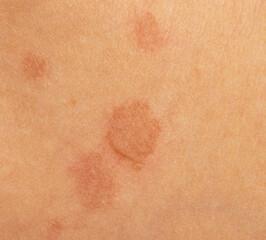Fototapeta premium round skin burns from hot oil