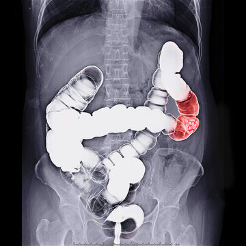 Barium Enema Image Or X-ray Image Of Large Intestine Prone Position  Showing Anatomical Of Colon For Detect Colon Cancer . Clipping Path.