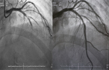 Comparison of pre-post percutaneous coronary intervention (PCI) at proximal to mid left anterior...